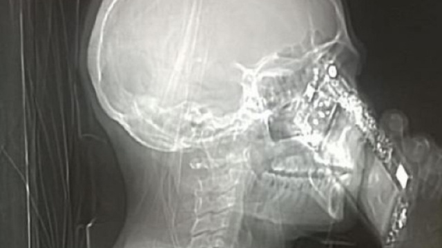 Napoli, risponde al telefono nel corso della Tac: svelata la foto dell'accaduto in ospedale