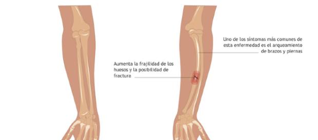 ¿Qué es la osteogénesis imperfecta? ¿Qué es la osteogénesis imperfecta?