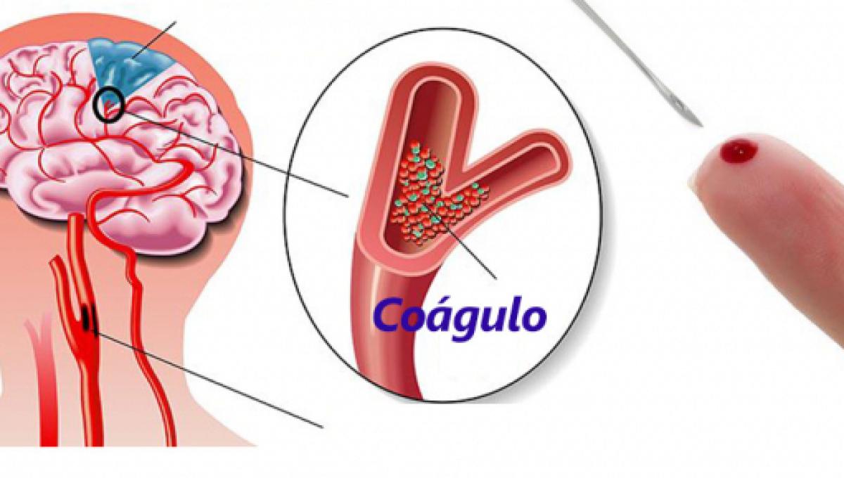 Que es un derrame cerebral causas