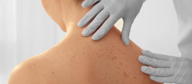 Por qué salen las manchas del sol en la piel - cosmeticos24h.com Por qué salen las manchas del sol en la piel - cosmeticos24h.com