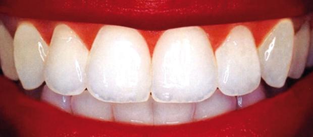 Cómo prevenir y tratar las caries dentales de forma natural — DSalud - dsalud.com Cómo prevenir y tratar las caries dentales de forma natural — DSalud - dsalud.com