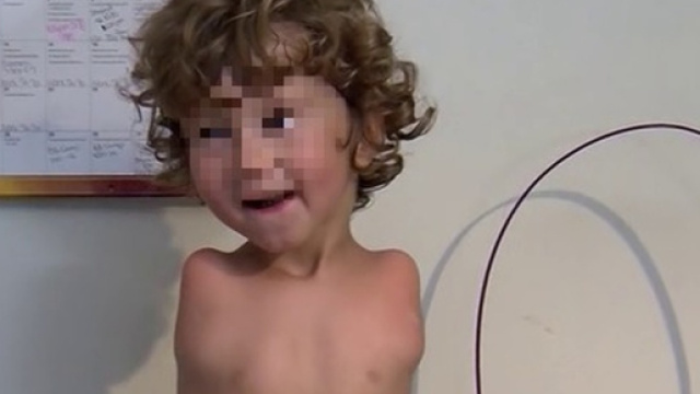 Non ha le braccia, bambino cacciato dal ristorante perch&eacute; antigienico mangiare con i piedi