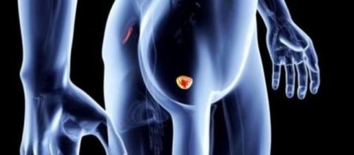 Tumore alla prostata: quali sono gli uomini che rischiano di più - blastingnews.com