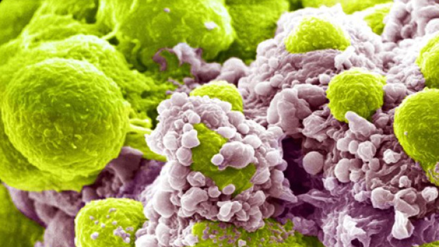 Il cancro della prostata, causato da cellule silenti che arrivano da ogni parte del corpo