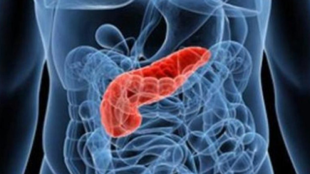 Tumore al pancreas, relazione con il diabete