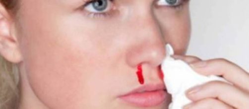 Hemorragia nasal o epistaxis ¿cuando preocuparse?