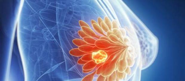 Secondo una ricerca molte donne non necessitano di chemioterapia. Secondo una ricerca molte donne non necessitano di chemioterapia.