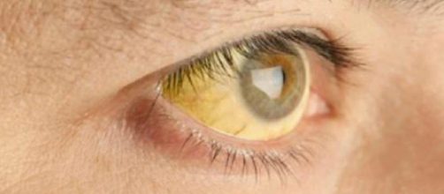 ojos amarillos: síntomas de Hepatitis tipo A