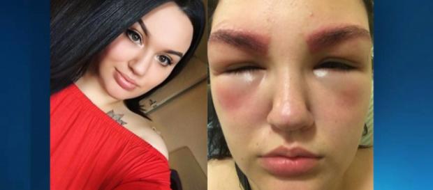 Hannah não passou por teste alérgico antes da pigmentação das sobrancelhas (Foto/Reprodução) Hannah não passou por teste alérgico antes da pigmentação das sobrancelhas (Foto/Reprodução)