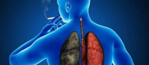 Cáncer de pulmón es uno de los más frecuentes en hombres | Aires ... - airesdelaciudad.com