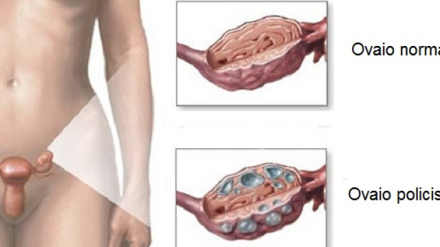 Probabilmente &egrave; un ormone prodotto dalle ovaie, l&rsquo;antimulleriano (AMH), la causa dell'ovaio policistico.