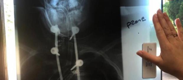 La princesa Eugenia compartió en su Instagram su batalla emocional con la escoliosis La princesa Eugenia compartió en su Instagram su batalla emocional con la escoliosis
