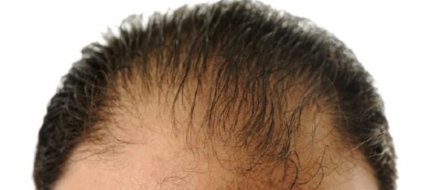 La calvizie si può curare: dall'Italia una nuova terapia poco costosa La calvizie si può curare: dall'Italia una nuova terapia poco costosa