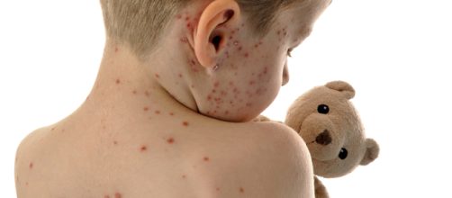 Morbillo, nel 2018 record di casi a livello europeo: l'Italia fra i paesi più colpiti