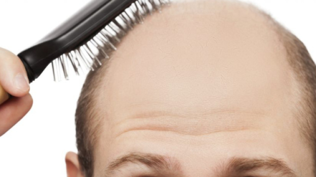 Calvizie: tutto quello che devi sapere - Microfibre di cheratina - microfibredicheratina.com