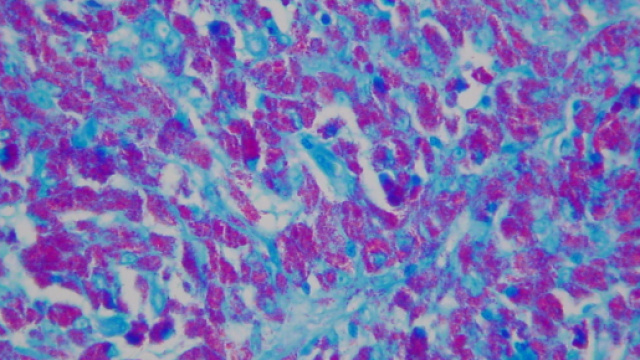 Nuova speranza per combattere i tumori: la cura CAR-T &egrave; pero costosa e rischiosa: ecco perch&egrave;