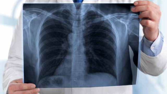 Polmonite: task force dei biologi ed inchiesta della Procura