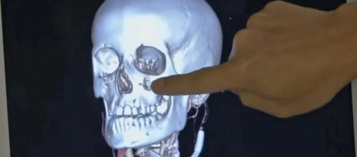 Missouri boy, 10, survives being impaled in the face by a metal meat skewer