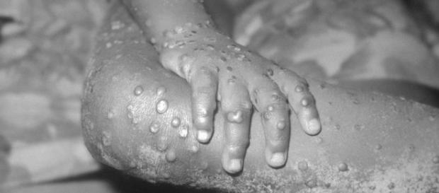 . A young boy infected with monkeypox Image credit Centers for Disease Control and Prevention . A young boy infected with monkeypox Image credit Centers for Disease Control and Prevention