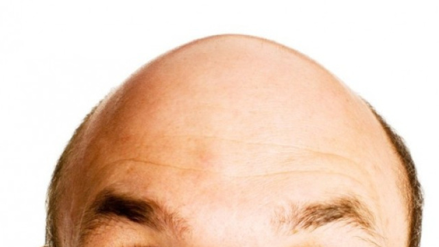 Calvizie: in Europa ogni anno il 15% in pi&ugrave; di trapianto capelli ... - gosalute.it