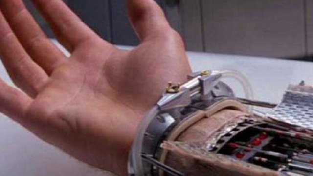 Medici installano una mano bionica a una donna