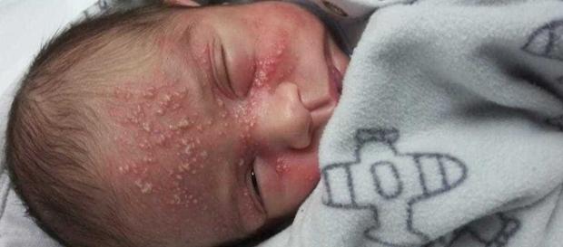 Bebê pegou herpes ainda na maternidade (Reprodução: Facebook) Bebê pegou herpes ainda na maternidade (Reprodução: Facebook)