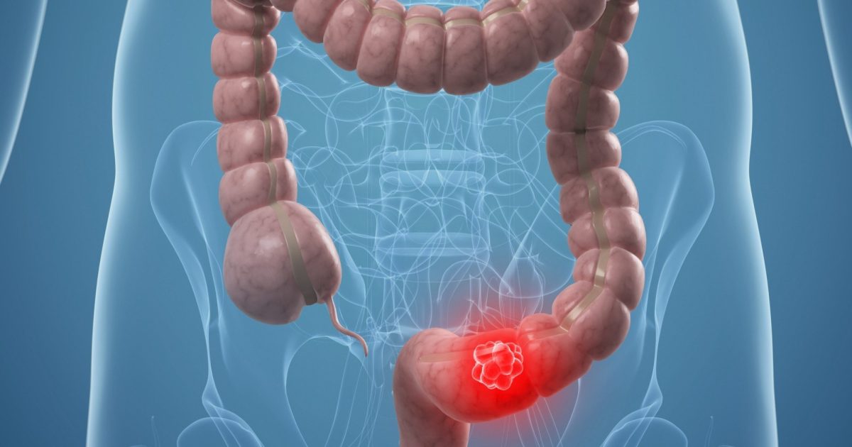 Cancro Al Colon-retto: Dieta E Altre Sane Abitudini Per Prevenirlo