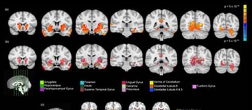 Scansioni di risonanza magnetica di cervello di adolescente consumatore e non: si evidenziano le alterazioni di volume in specifiche aree