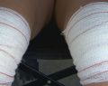 Mulher acusa hospital de lhe ter operado o joelho errado em MG