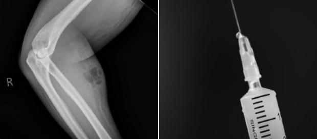 O homem comprou agulha online e injetou o próprio sêmen por 18 meses. (Crédito: Raio X via Irish Medical Journal, Dunne L.) O homem comprou agulha online e injetou o próprio sêmen por 18 meses. (Crédito: Raio X via Irish Medical Journal, Dunne L.)