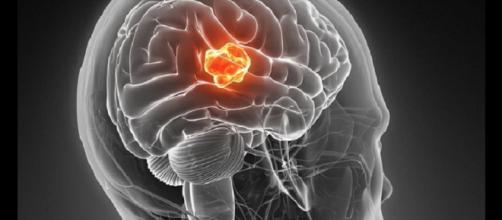 Il glioblastoma è un tumore cerebrale molto aggressivo e finora con scarse opzioni terapeutiche.