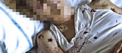 Formiche sul volto di un paziente al S.Giovanni Bosco: l'ira del ministro Grillo