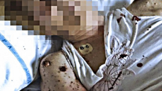 Formiche sul volto di un paziente al S.Giovanni Bosco: l'ira del ministro Grillo