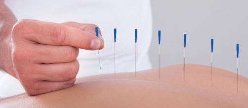 Canada, vive per 30 anni con aghi da agopuntura attaccati alla schiena