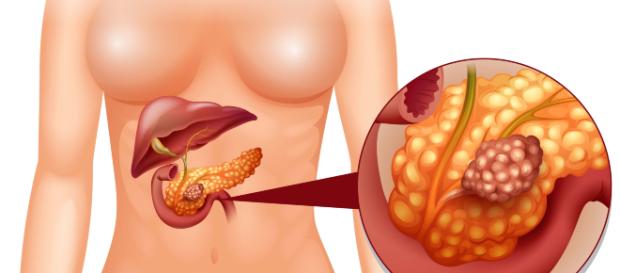 I principali fattori di rischio del tumore al pancreas. I principali fattori di rischio del tumore al pancreas.