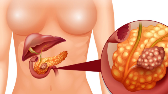 I principali fattori di rischio del tumore al pancreas.