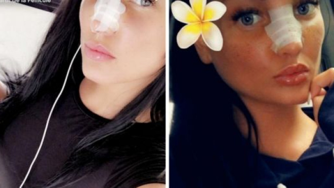 Aurélie Dotremont : après sa rhinoplastie, elle dévoile le résultat ! - gossip-room.fr