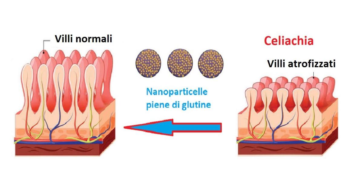 Uno Studio Clinico Di Fase 2 Mostra Che La Celiachia Può Essere Bloccata