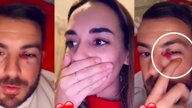 Julien Bert gravement blessé à l’œil à cause de sa chérie Hilona, il raconte tout. @Snapchat : Julien Bert / Hilona.