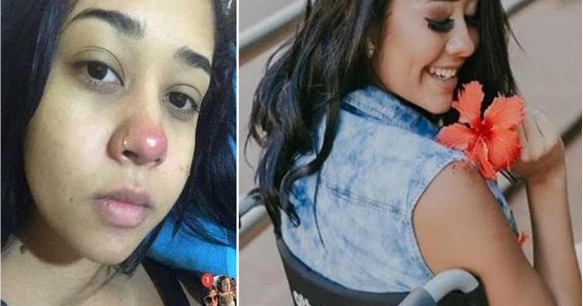 Jovem fica paraplégica após a colocação de um piercing no nariz