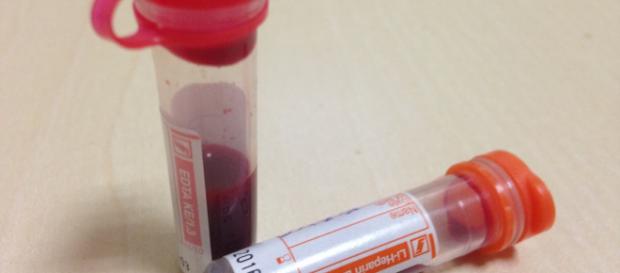 La sangre dorada o Rh neutro, un problema para sus portadores La sangre dorada o Rh neutro, un problema para sus portadores