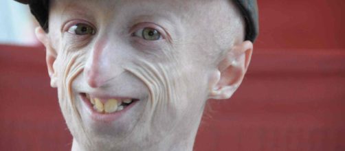 Sammy Basso, il 23enne malato di progeria operato con successo al ... - ultimavoce.it