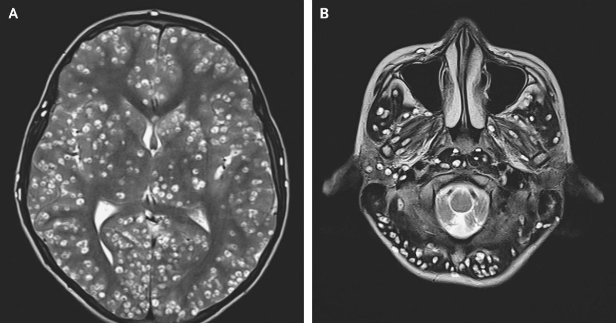 Jovem morre na Índia após descobrir parasitas no cérebro