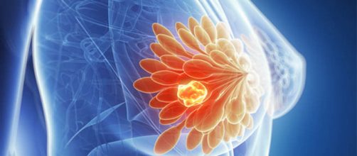 Cancro alla mammella: uno studio recente individua un nuovo approccio grazie ad alcuni geni.