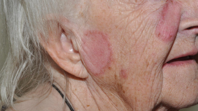 JIM.fr - Lupus : no smoking ! - jim.fr