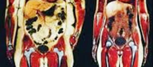 Alcuni probiotici contrastano grasso epatico e viscerale. Alcuni probiotici contrastano grasso epatico e viscerale.