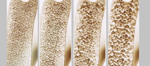 Negli Stati Uniti la FDA ha approvato un nuovo farmaco contro l’osteoporosi. Si Chiama Evenity ed è un anticorpo monoclonale umanizzato.
