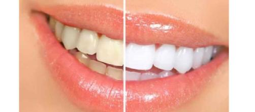 Sempre più diffusi i prodotti per lo sbiancamento dei denti ma questi possono essere anche pericolosi se usati in modo improprio