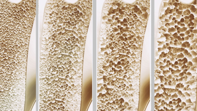 Negli Stati Uniti la FDA ha approvato un nuovo farmaco contro l’osteoporosi. Si Chiama Evenity ed è un anticorpo monoclonale umanizzato.