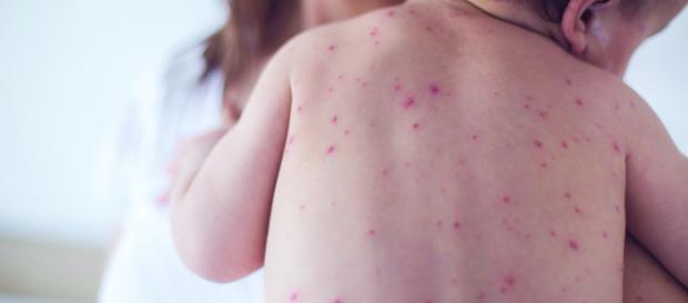 Secondo l'OMS è in atto un'epidemia mondiale di morbillo. Secondo l'OMS è in atto un'epidemia mondiale di morbillo.
